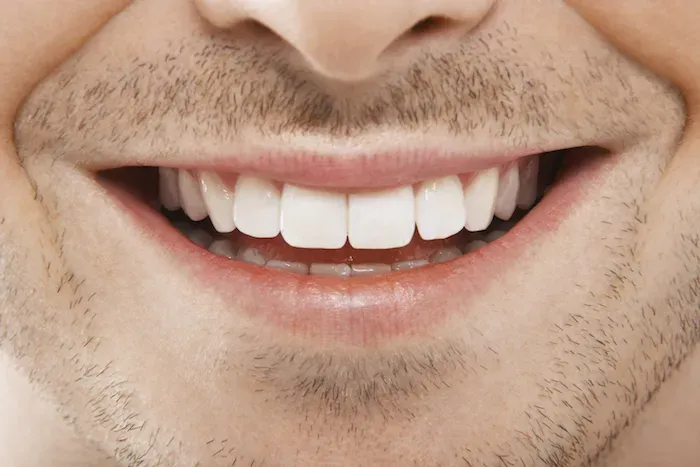 "Turkey teeth" is a term used to describe cosmetic dental procedures performed in Turkey